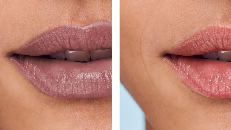 Dịch vụ Khử thâm môi Nam / Nữ của Luxie