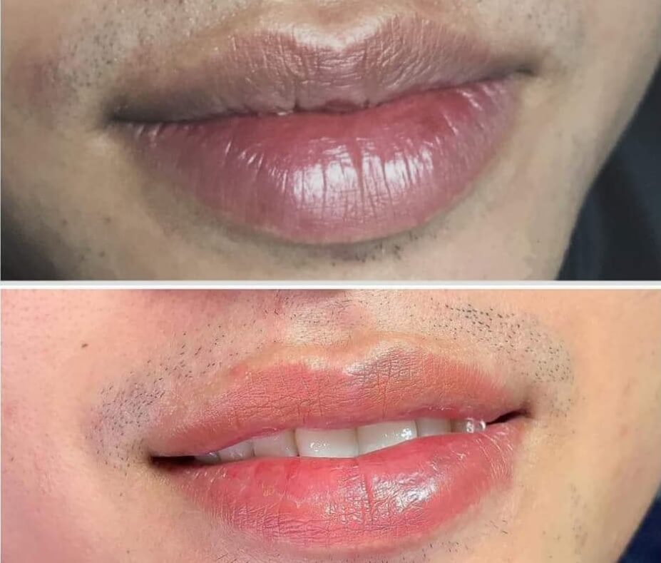 Nam giới cũng sử dụng dịch vụ khử thâm môi