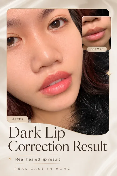 Dark Lip Correction Result In Hcmc